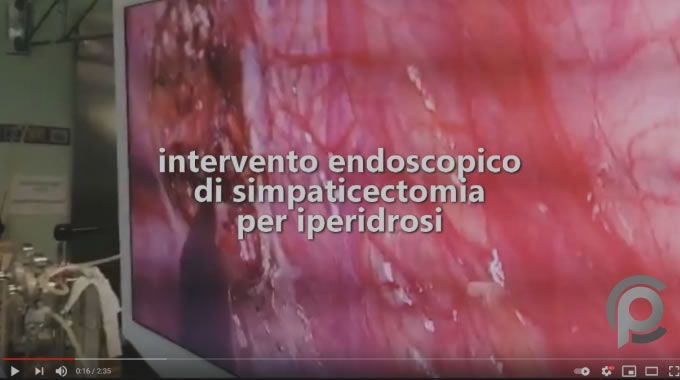 Intervento endoscopico di simpaticectomia per iperidrosi